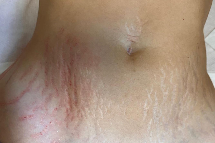 Estómago de paciente antes de someterse a tratamiento para difuminar sus estrías rojas