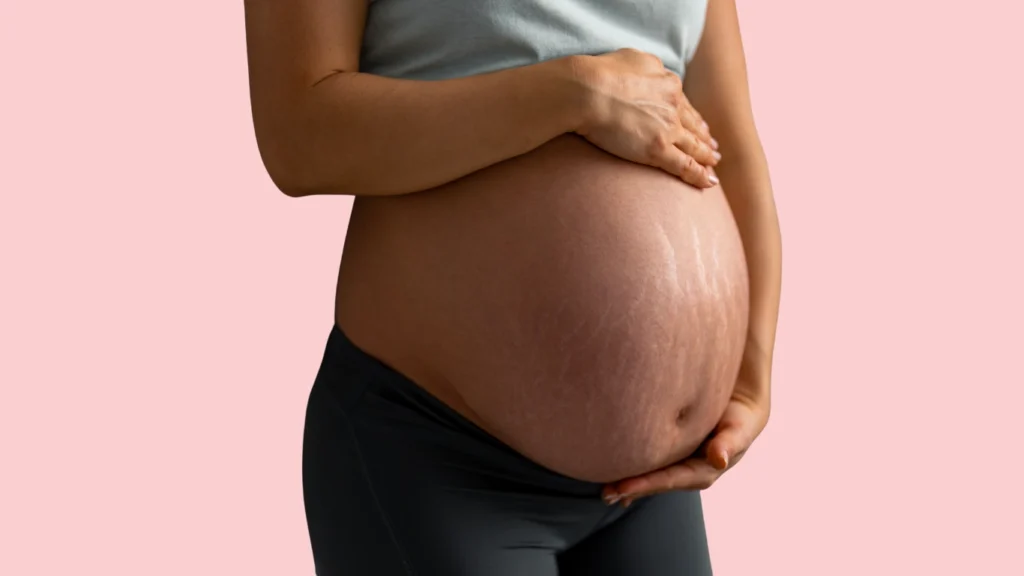 Mujer embarazada con estrías marcadas en estómago